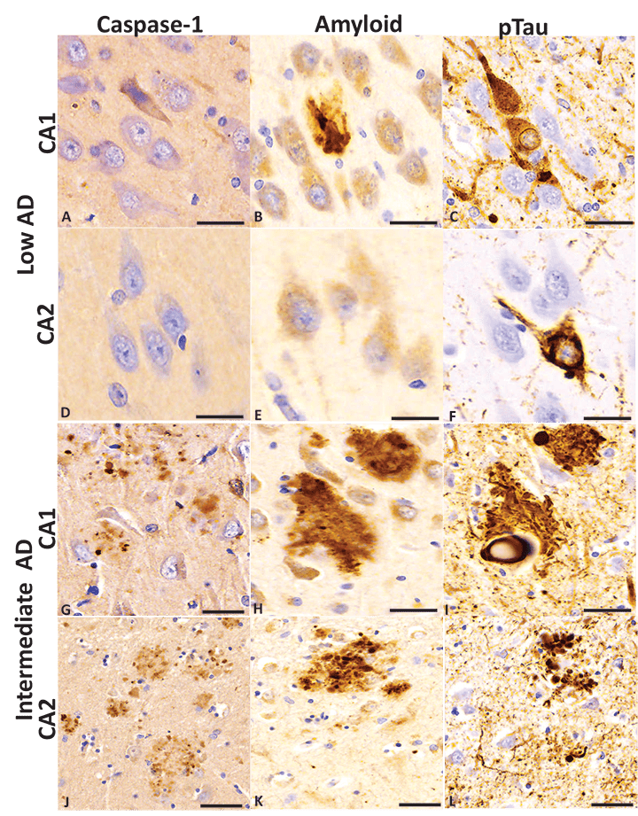 The Inflammasome for Understanding and Combating Neurodegenerative Diseases